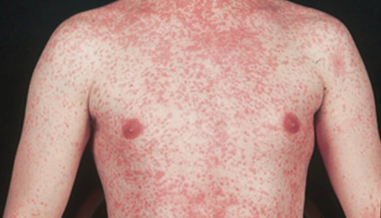 Measles Rash-photo