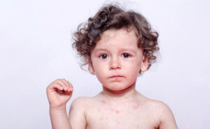 Measles in the news