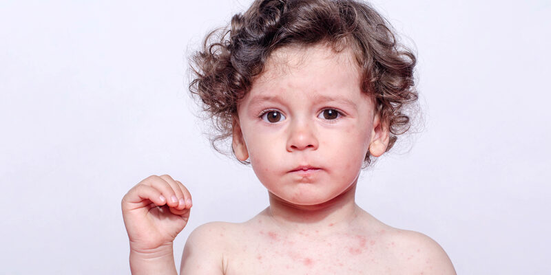 Measles in the news
